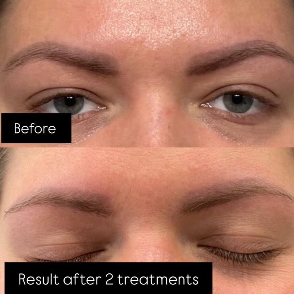 Permanent Makeup Removal | Remover