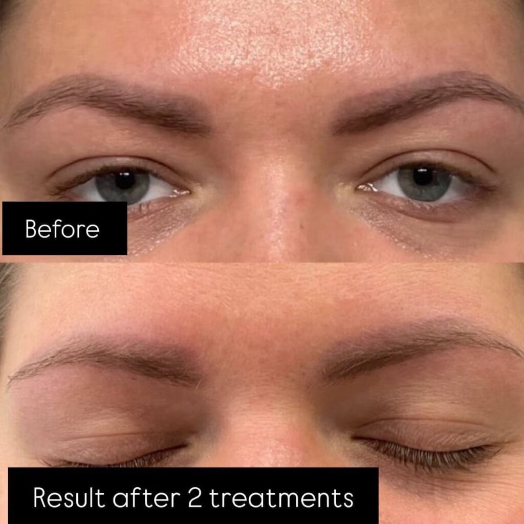 permanent makeup remover